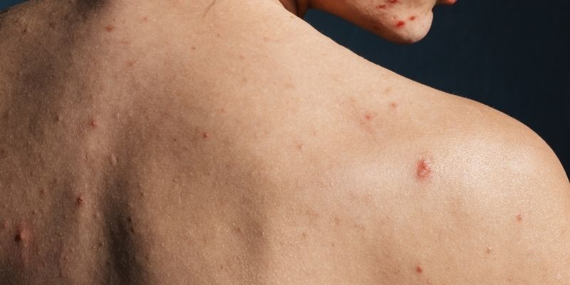 How to Effectively Treat Back Acne Scars and Improve Your Skin Texture
